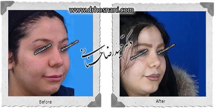 اصلاح انحراف بینی