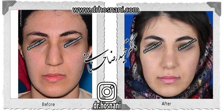  جراحی بینی -580
