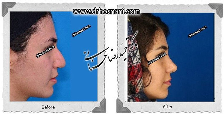  جراحی بینی -581