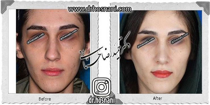 اصلاح انحراف بینی