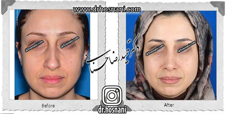 جراحی بینی