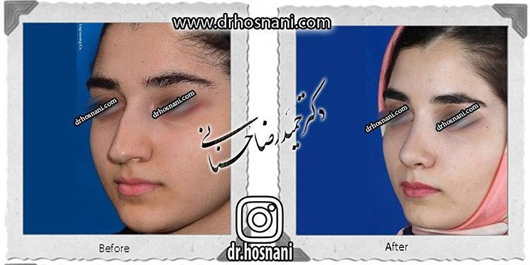 کاهش طول بینی