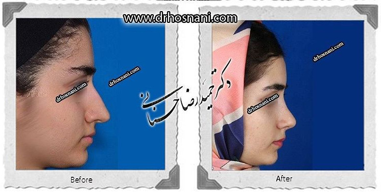 کاهش طول بینی