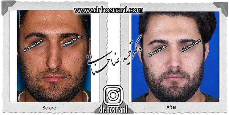 اصلاح انحراف بینی