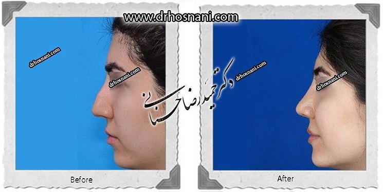 اصلاح انحراف بینی