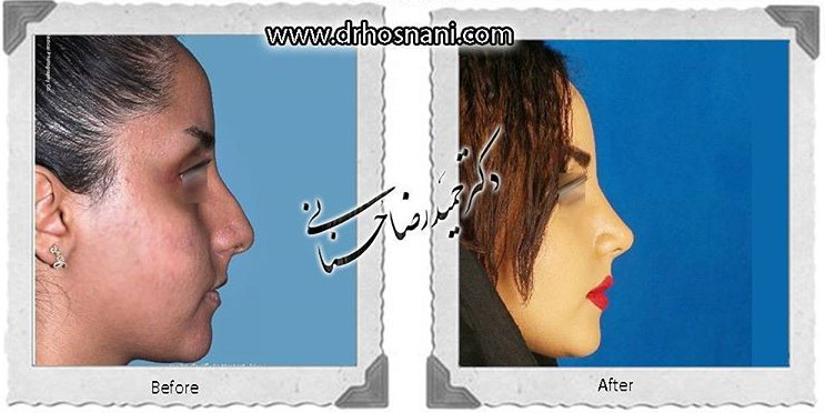 اصلاح انحراف بینی