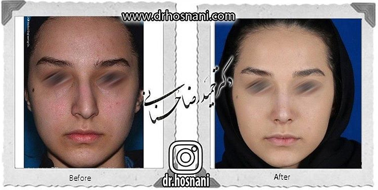 اصلاح انحراف بینی
