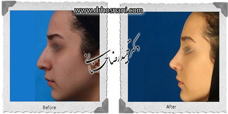 اصلاح انحراف بینی