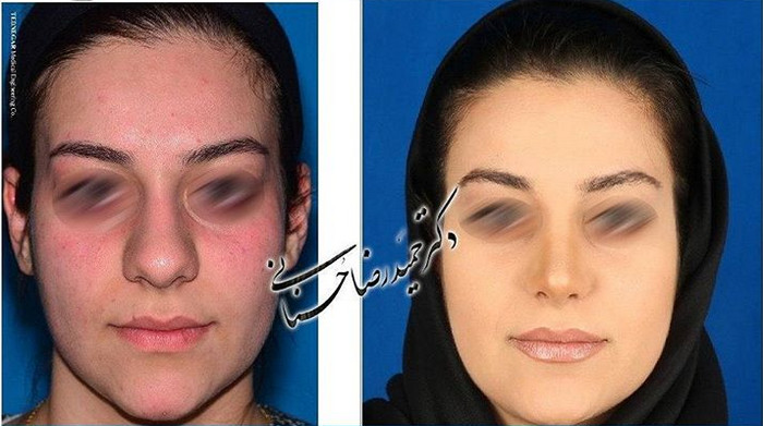  جراحی بینی -596