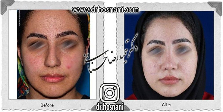 اصلاح انحراف بینی