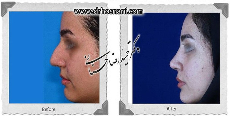 اصلاح انحراف بینی