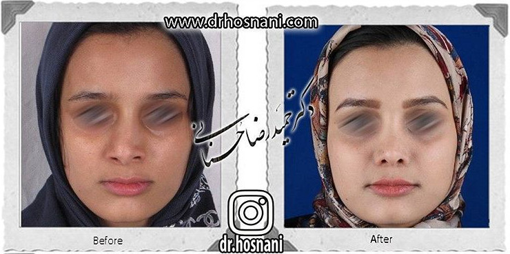 اصلاح انحراف بینی