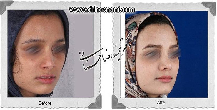 اصلاح انحراف بینی