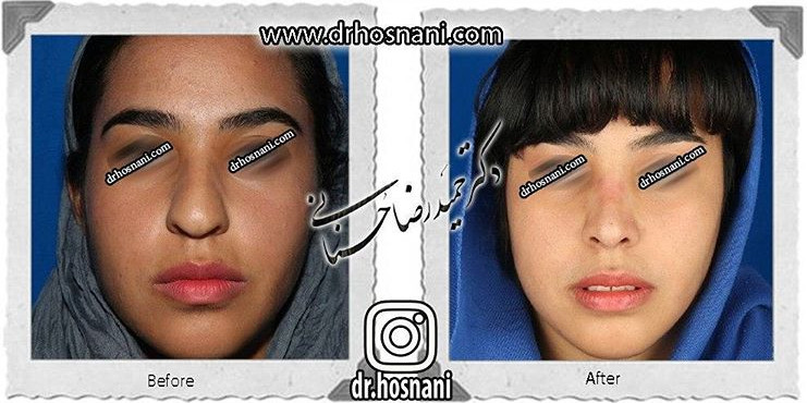 جراحی بینی