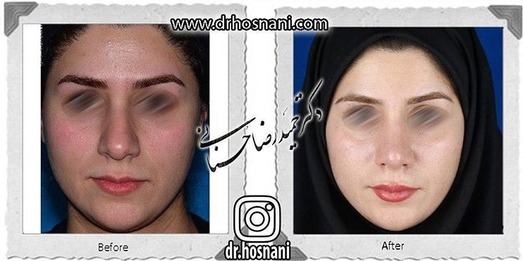 جراحی بینی
