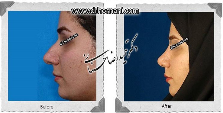 جراحی بینی