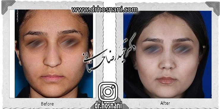 اصلاح انحراف بینی