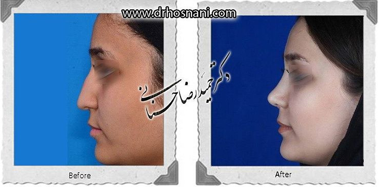 اصلاح انحراف بینی