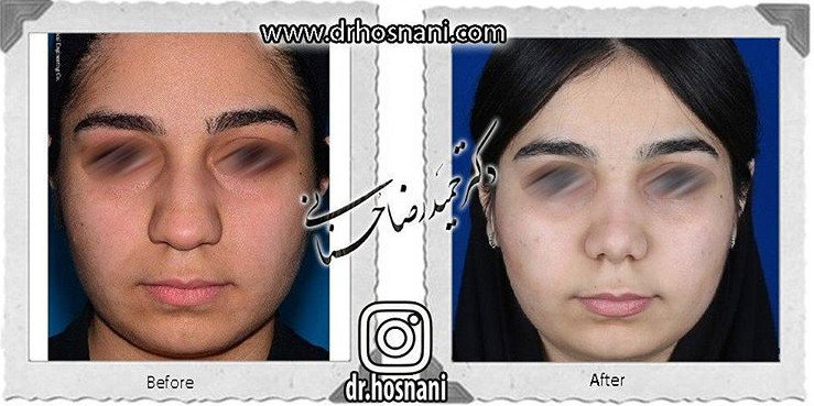  جراحی بینی -609