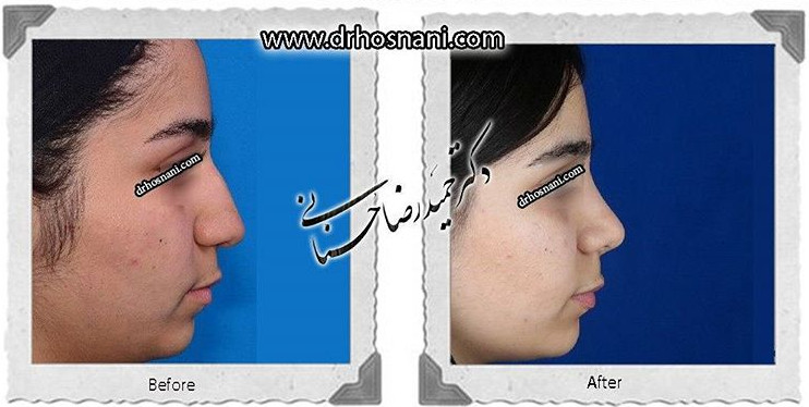  جراحی بینی -610