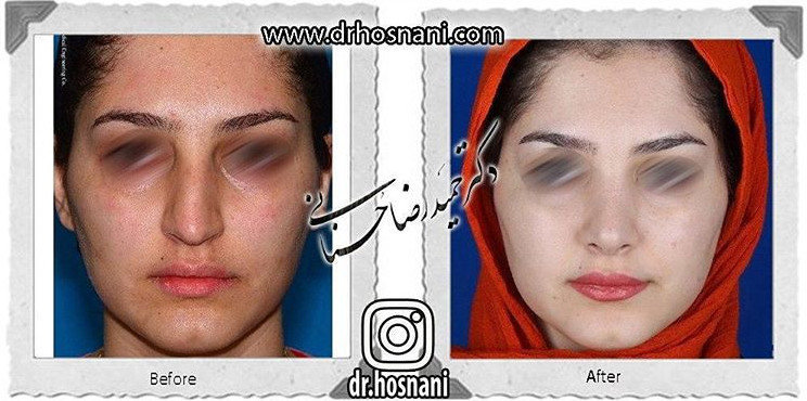 اصلاح انحراف بینی