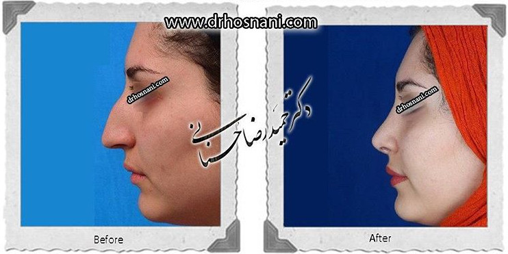 اصلاح انحراف بینی