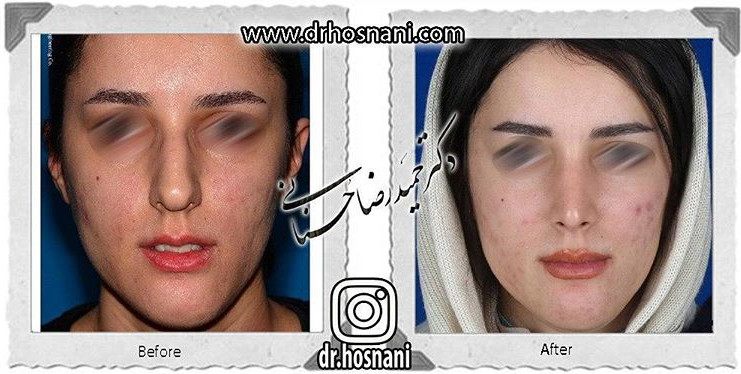  جراحی بینی -615
