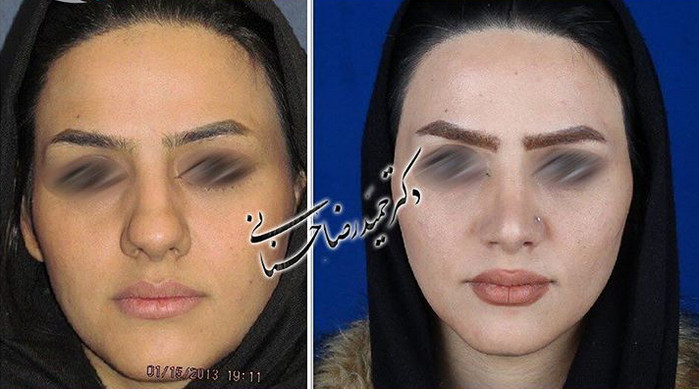  جراحی بینی -617