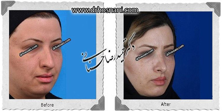 جراحی بینی