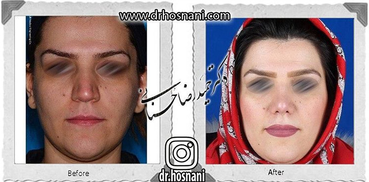 جراحی بینی