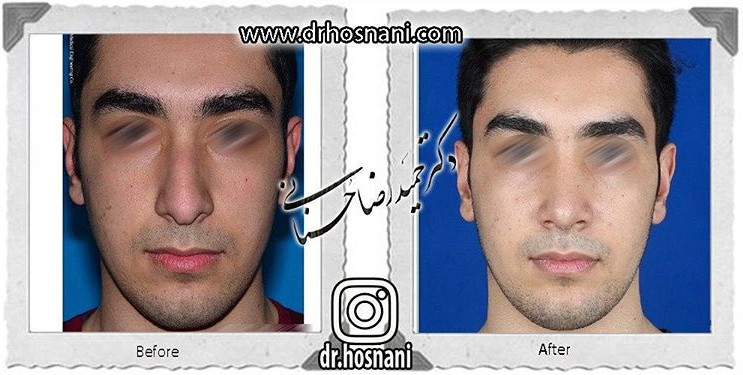 جراحی بینی