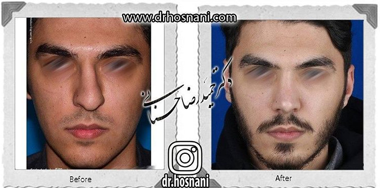 اصلاح انحراف بینی