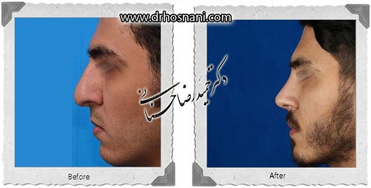 اصلاح انحراف بینی