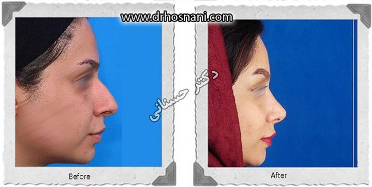 جراحی بینی