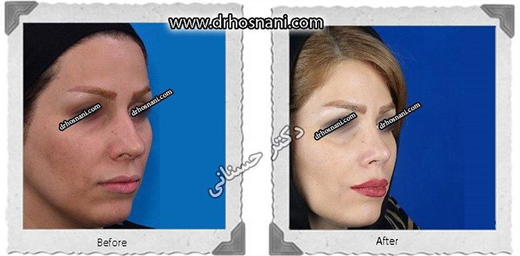 کاهش طول بینی