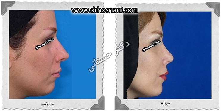 کاهش طول بینی
