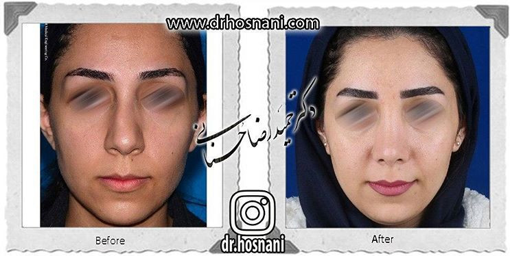 اصلاح انحراف بینی