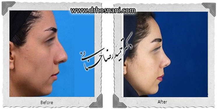 اصلاح انحراف بینی