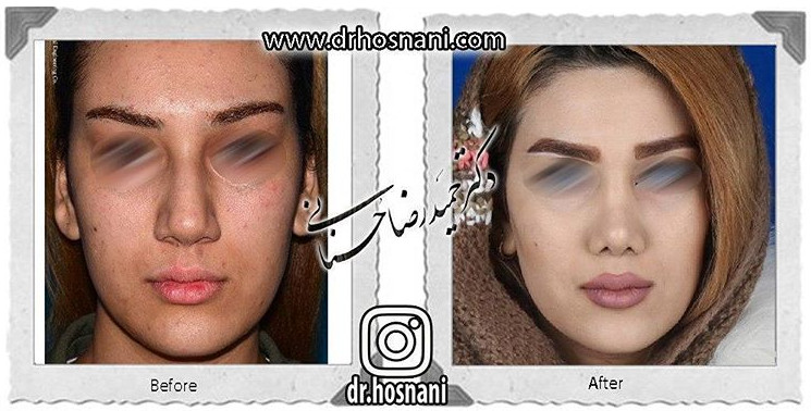  جراحی بینی -637