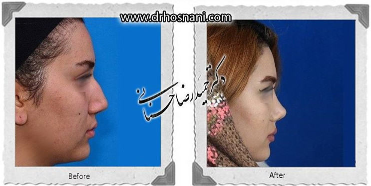  جراحی بینی -638