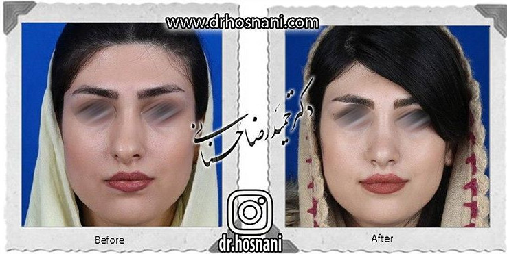 اصلاح انحراف بینی