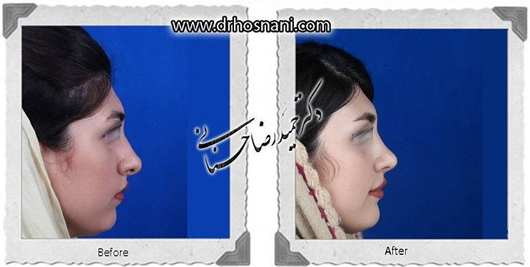 اصلاح انحراف بینی