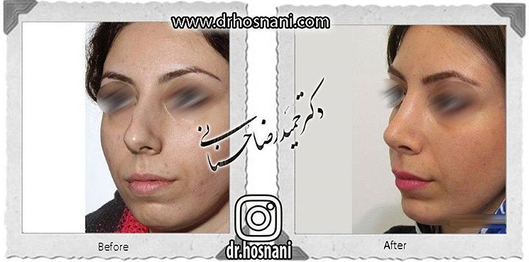 جراحی بینی
