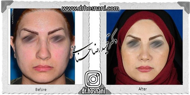 اصلاح انحراف بینی