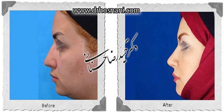 اصلاح انحراف بینی