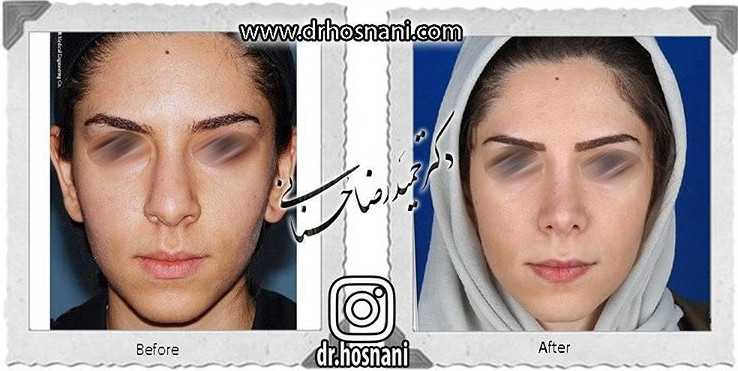 جراحی بینی