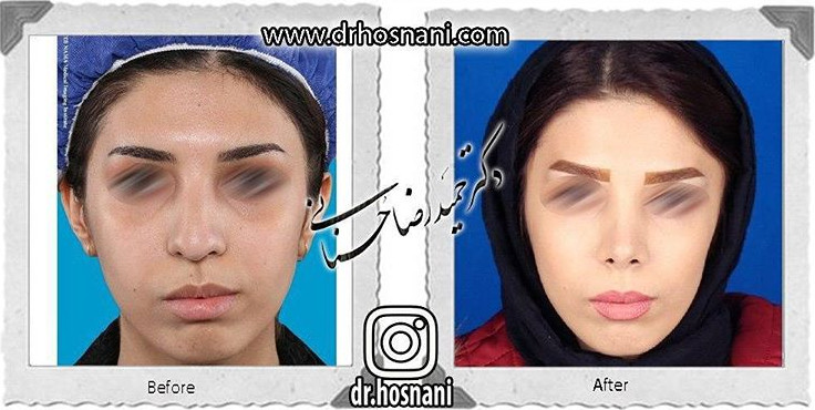 اصلاح انحراف بینی
