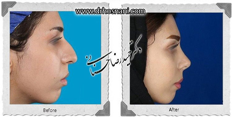 اصلاح انحراف بینی
