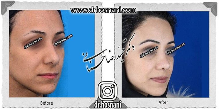  جراحی بینی -651