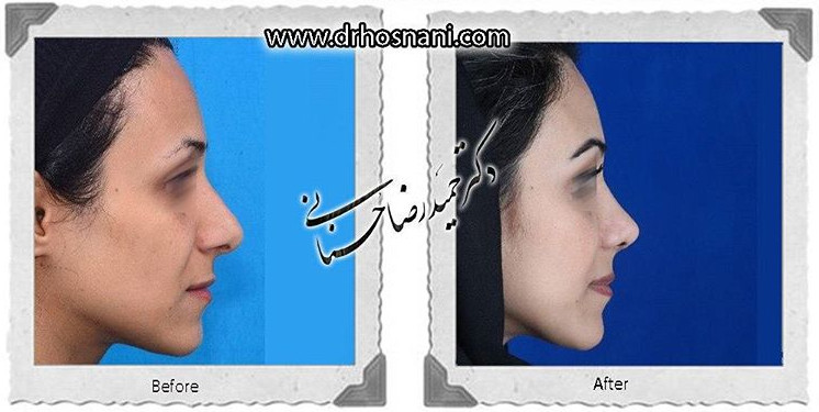  جراحی بینی -652